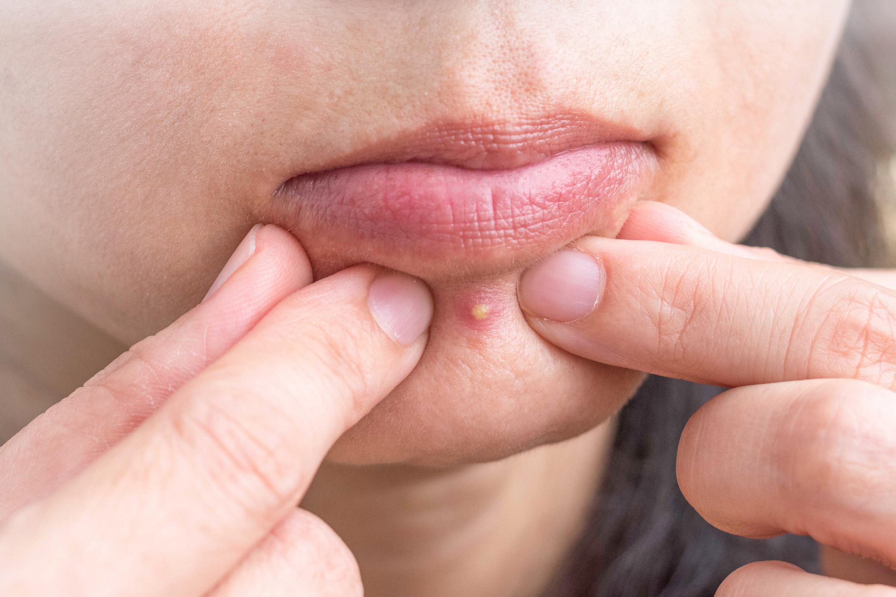 Pustules (boutons rouges inflammatoires)